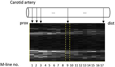 Single M-Line Is as Reliable as Multiple M-Line Ultrasound for Carotid Artery Screening